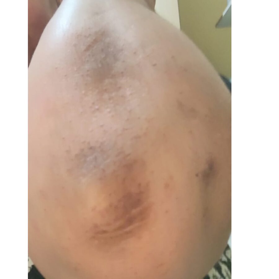 Cotovelo depois do uso de Mivs