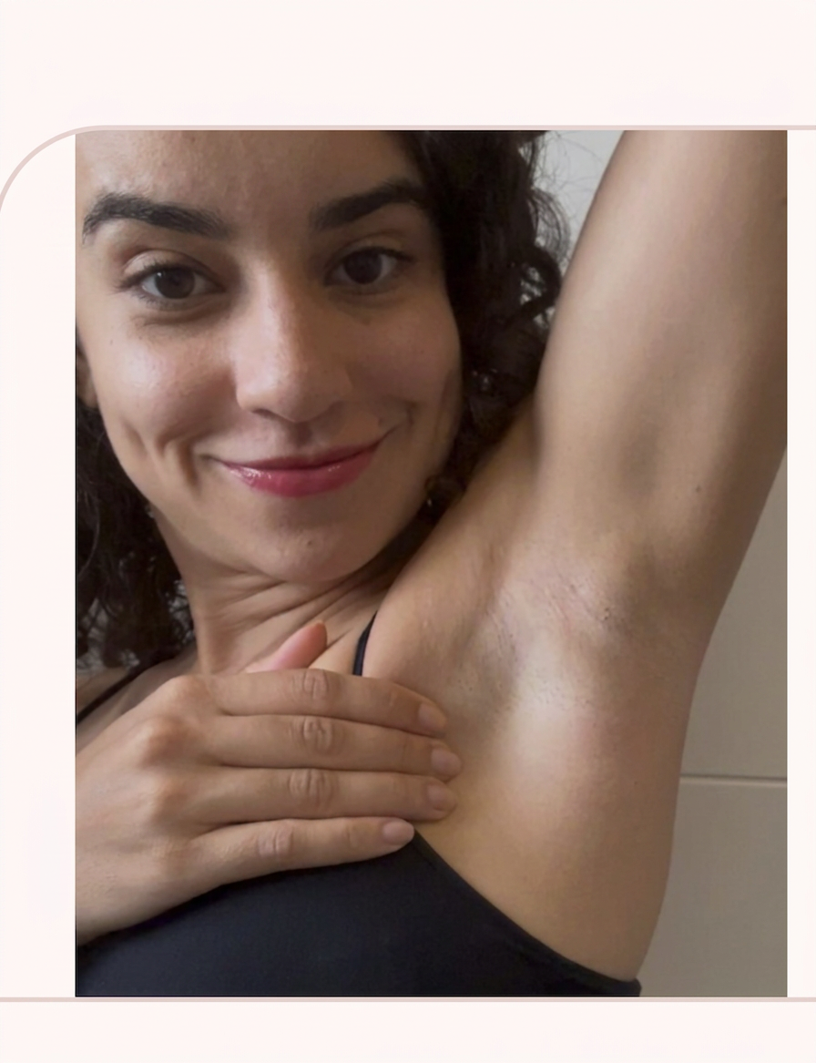Axilas depois do uso de Mivs